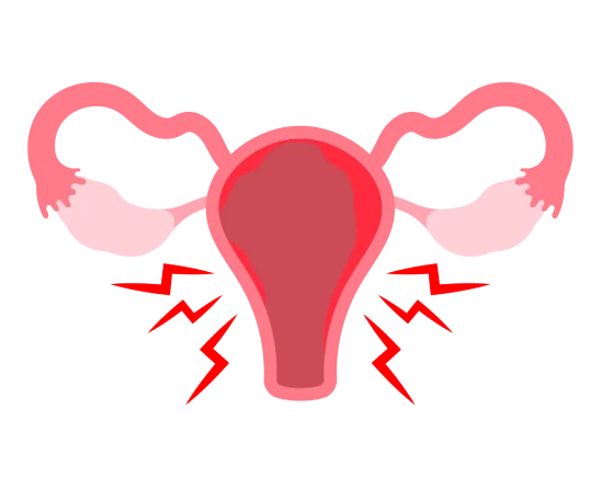endometriosis1